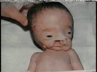 radiation deformed Iraqi baby