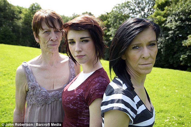  mother (left) and daughter 16 (right) have lipodystrophy, middle daughter doesn't ! ”  
