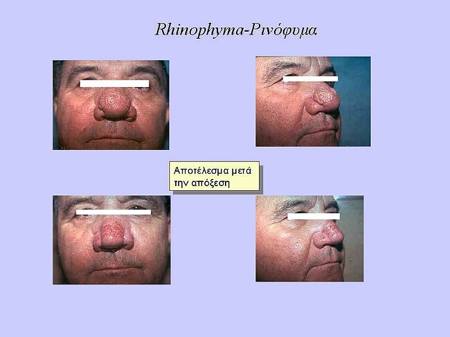 rhinophyma.jpg