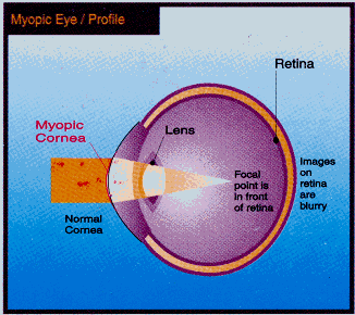 Myopia: light path in the eye.