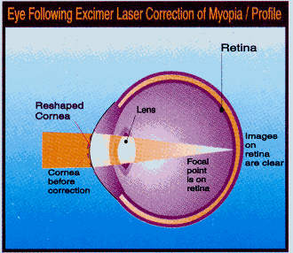 Myopia: light path in eye after laser.