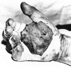 Daghlian's Right Hand