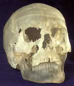Skull of Iceman