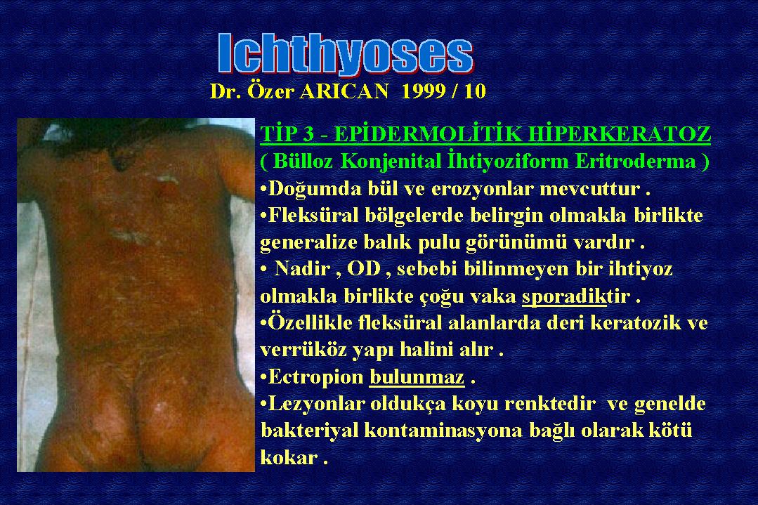 Ichthyosis10