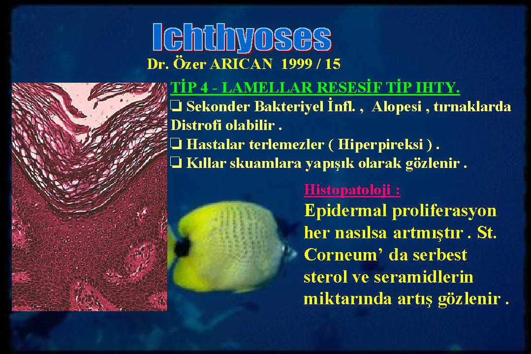 Ichthyosis15
