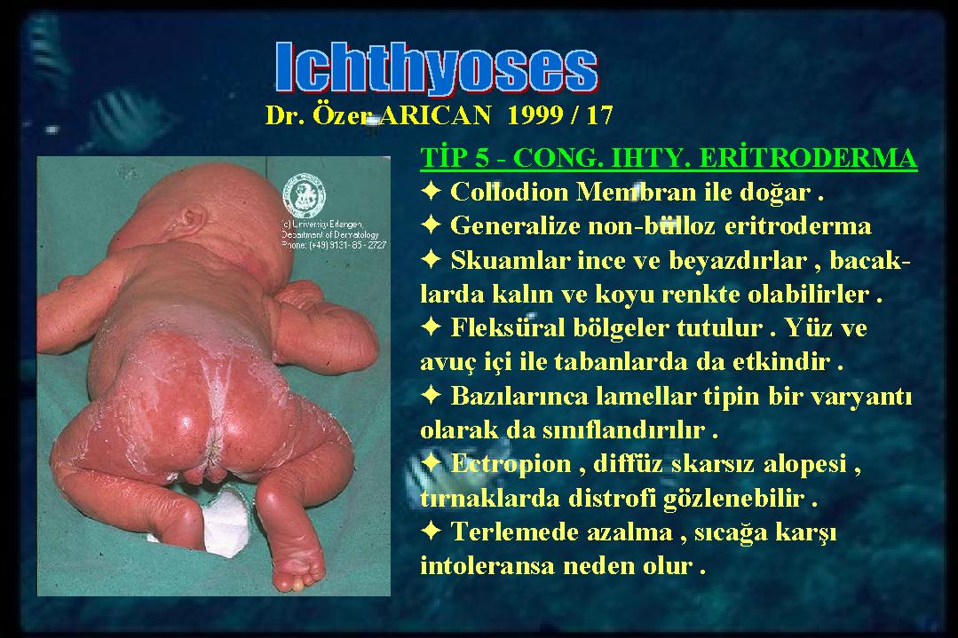 Ichthyosis17