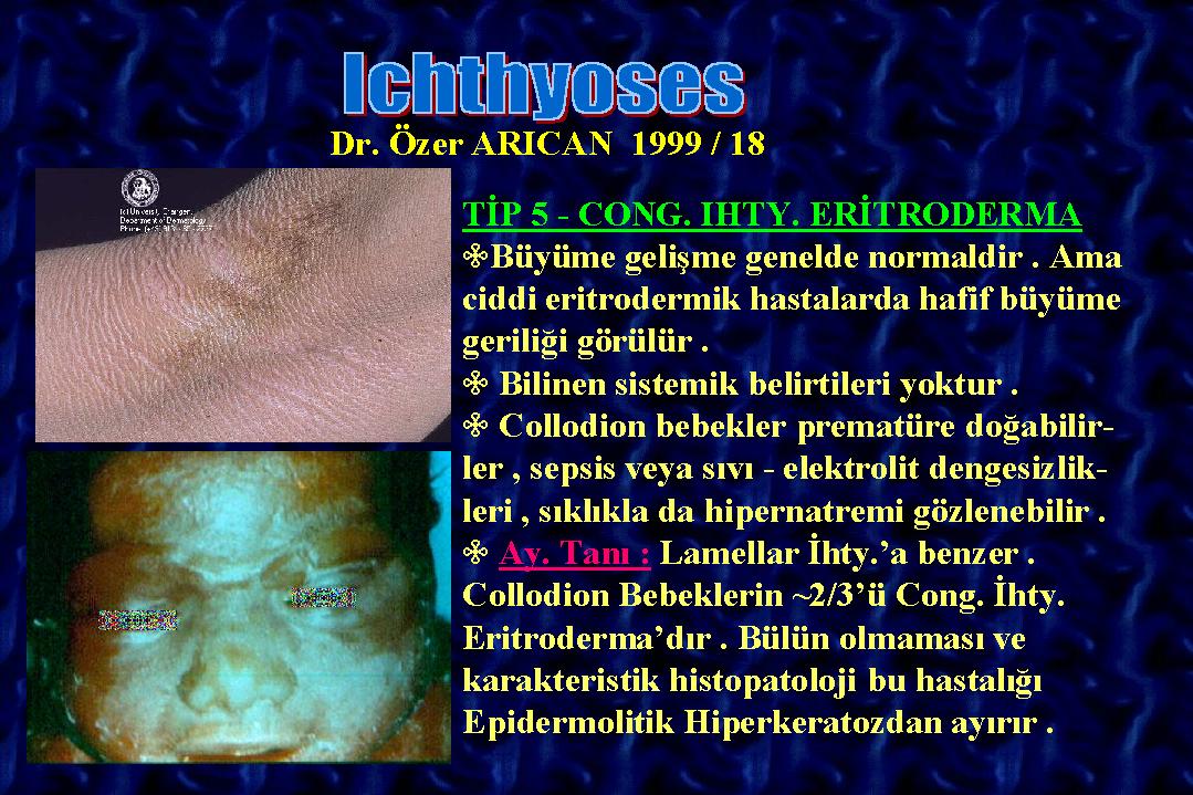Ichthyosis18