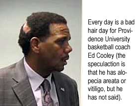 Every day is a bad hair day for Providence University basketball coach Ed Cooley (the speculation is that he has alopecia areata or vitiligo, but he has not said)