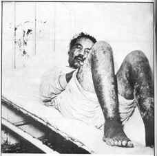 Don Pedro Albizu after the radiations to which he was exposed to by the government of the USA